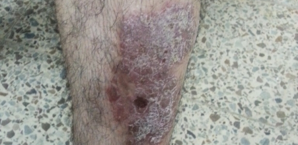 Port-wine hemangioma | Dermatology Oasis